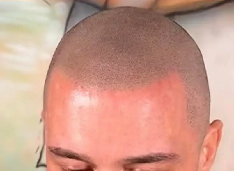 Startseite Scalp Micropigmentation Beispiel